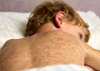 Спалахи кору в Європі: як українським біженцям уберегтися від однієї з найнебезпечніших інфекцій