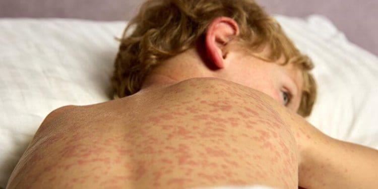 Спалахи кору в Європі: як українським біженцям уберегтися від однієї з найнебезпечніших інфекцій